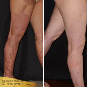 burn reconstructive surgery clinic in Pakistan