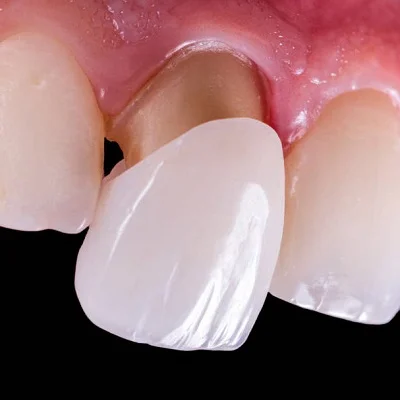 Dental Veneers vs Crowns