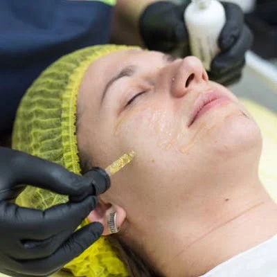Hyaluronic Acid and Acne Scars A Promising Treatment