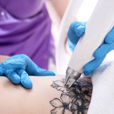 Is laser tattoo removal safe