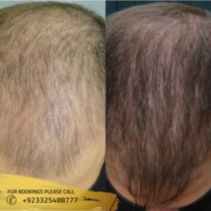 PRP Hair Treatment before after results