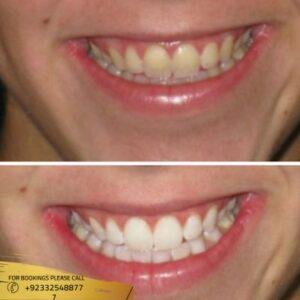 Results of Teeth Whitening Strips