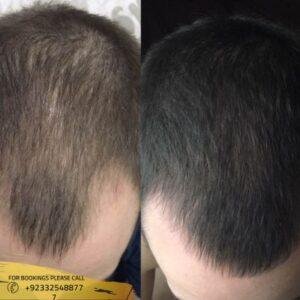 Results of Front Line Hair Fixing