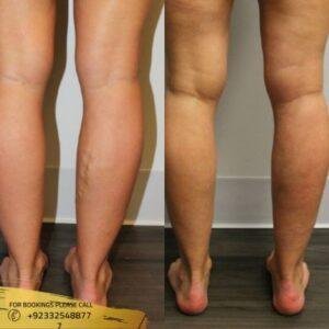 Calf Reduction before and after