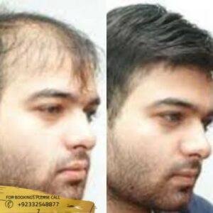Non-surgical Hair Replacement before and after