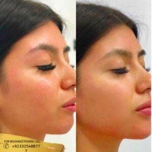 Jawline Contouring Treatment cost in Islamabad