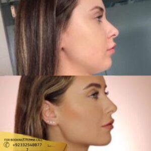 Results of Jawline Contouring Treatment