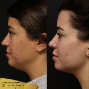 Belkyra Treatment before and after