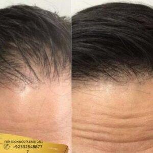 ACell Hair Loss Therapy cost of Islamabad