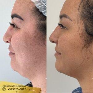 Belkyra Treatment cost in Islamabad