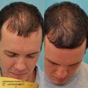 Results of ACell Hair Loss Therapy