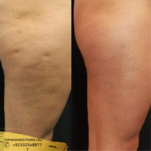 cellulite removal before and after
