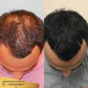 ACell Hair Loss Therapy before and after