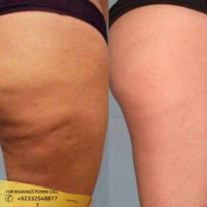 cellulite removal cost in Islamabad