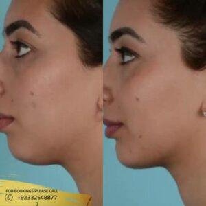 Results of Belkyra Treatment