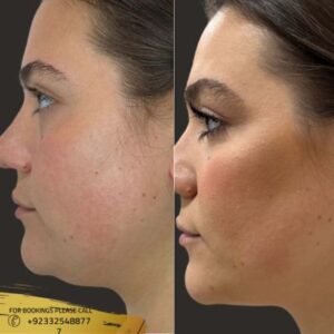 Kybella Treatment cost in Islamabad