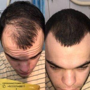 Front Line Hair Fixing cost in Islamabad