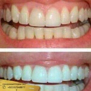 Teeth Whitening Strips cost in islamabad
