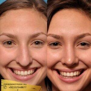 septoplasty surgery cost in Islamabad