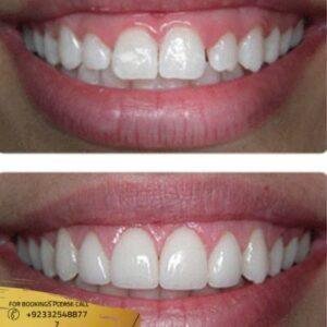 gum grafting before and after