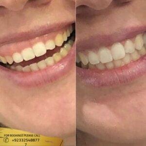 Results of gum grafting
