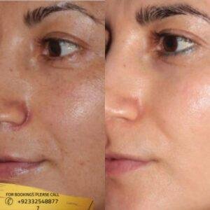 Skin Rejuvenation cost in Islamabad