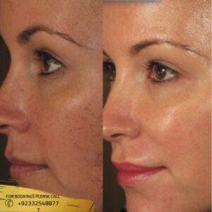 Skin Rejuvenation before and after