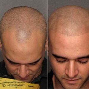 Scalp Micropigmentation before and after