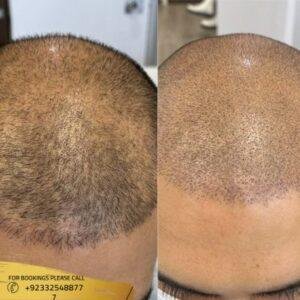 Results of Scalp Micropigmentation