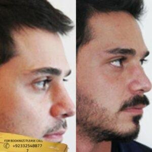 mustache hair transplant before and after