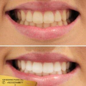 Teeth Whitening Strips before and after