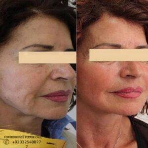 Results of Laser Skin Tightening