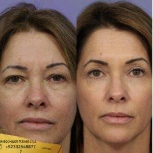 Laser Skin Tightening cost in Islamabad