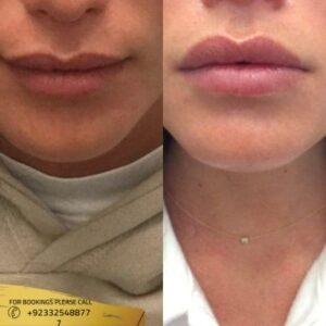 Botox Lip Flip before and after