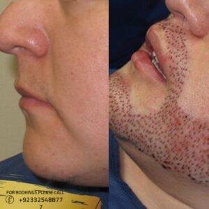 mustache hair transplant cost in Islamabad