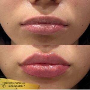 Russian lip fillers before and after