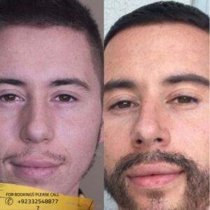 Results of mustache hair transplant