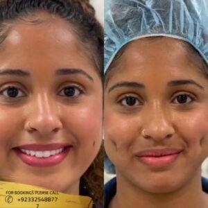 results of dimple creation