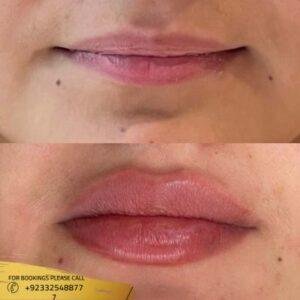 Results of Russian lip fillers