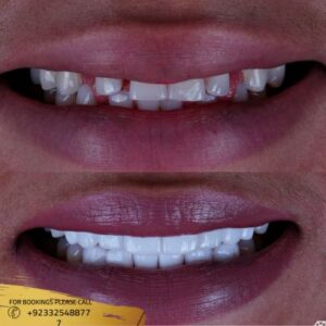 Results of Dental Crown