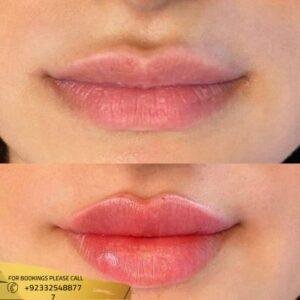 Russian lip fillers cost in Islamabad