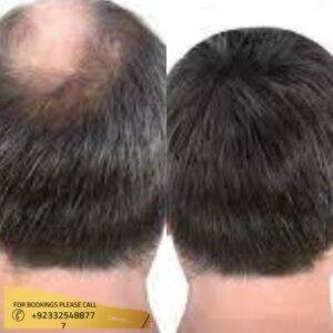 Non-surgical Hair Replacement cost in Islamabad