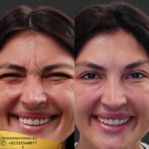 Botox injections cost in Islamabad