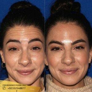 Results of Botox injections Islamabad