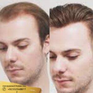 Results of Non-surgical Hair Replacement