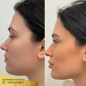 Jawline Contouring Treatment before and after