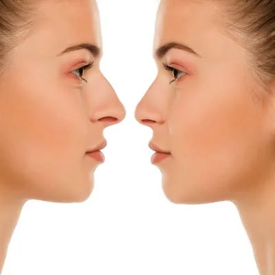 Will My Sense of Smell Remain Intact Following Rhinoplasty Surgery