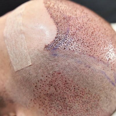 hair transplant in pakistan