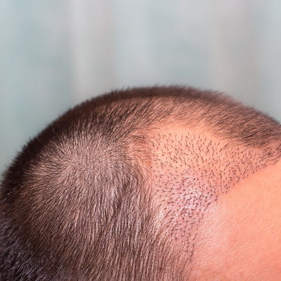 Is it Expensive to Get a Hair Transplant?