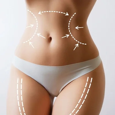 7 Things to Expect from Liposuction in Islamabad